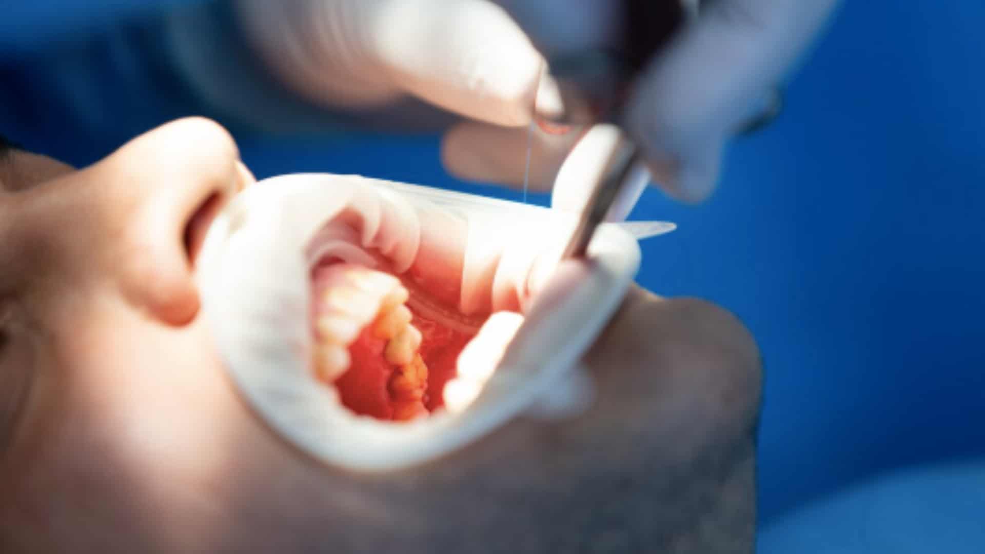 benefits of fluoride treatment